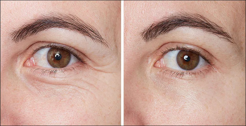 educing the visibility of wrinkles