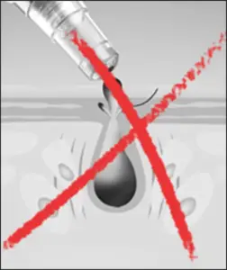 strong force sucking causes enlarged pores
