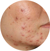 Daily Acne Care for Young, Oily Skin