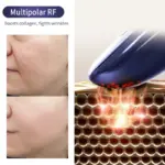 RF Beauty Device