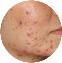 Daily Acne Care for Young, Oily Skin