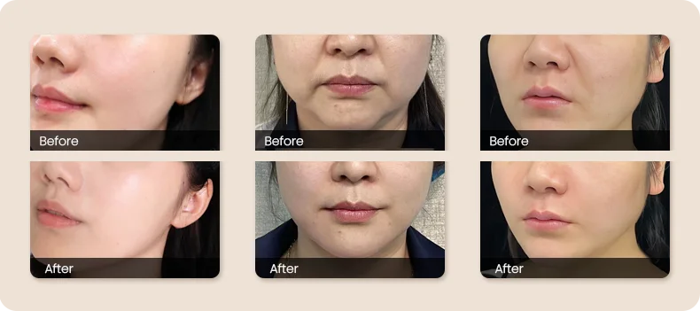 Skin Tightening Device(images 18)