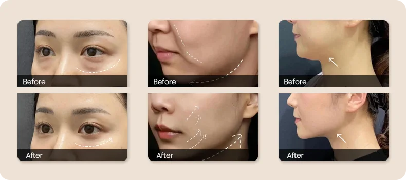 Skin Tightening Device(images 17)