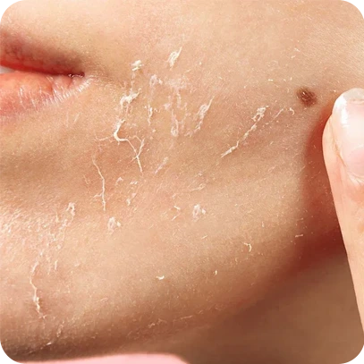 Dry& Flaky Skin