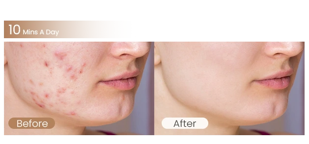 415nm (blue) + 630nm (red)